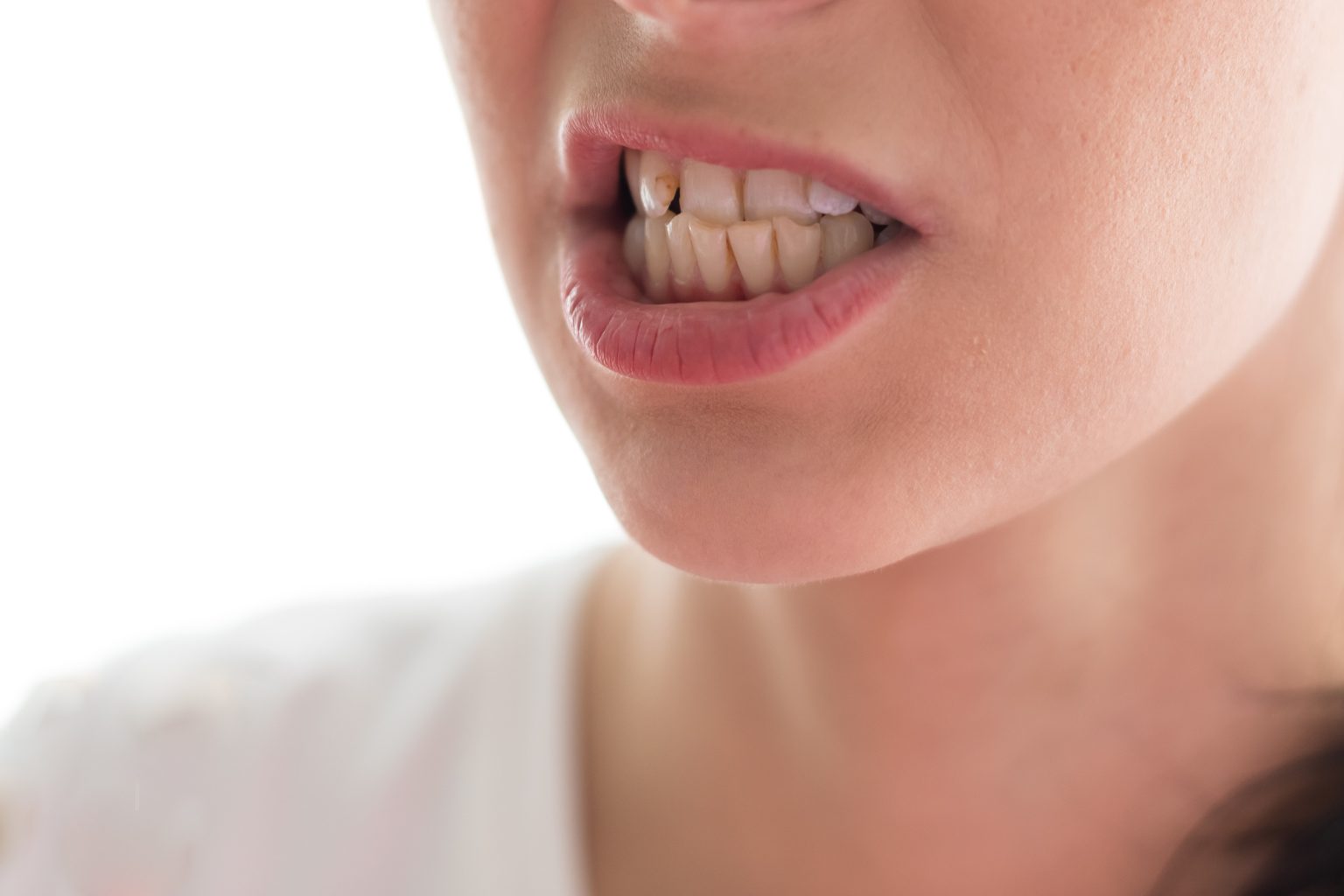 Common Causes Of Teeth Grinding Houston, TX